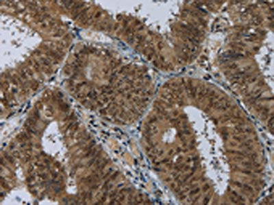 The image on the left is immunohistochemistry of paraffin-embedded Human colon cancer tissue using the antibody Antibody) at dilution 1/60, on the right is treated with fusion protein. (Original magnification: ×200)