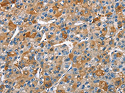 The image on the left is immunohistochemistry of paraffin-embedded Human liver cancer tissue using BCL10 Antibody(BCL10 Antibody) at dilution 1/40, on the right is treated with fusion protein. (Original magnification: ×200)
