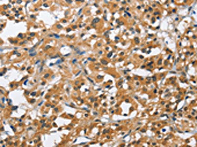 The image on the left is immunohistochemistry of paraffin-embedded Human thyroid cancer tissue using the antibody Antibody) at dilution 1/40, on the right is treated with fusion protein. (Original magnification: ×200)