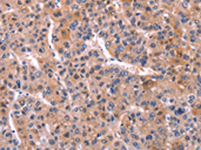 The image on the left is immunohistochemistry of paraffin-embedded Human liver cancer tissue using TNFRSF17 Antibody(TNFRSF17 Antibody) at dilution 1/30, on the right is treated with synthetic peptide. (Original magnification: ×200)Rabbit anti-Human TNFRSF17 Polyclonal Antibody