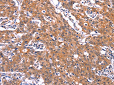 The image on the left is immunohistochemistry of paraffin-embedded Human gastic cancer tissue using the antibody Antibody) at dilution 1/30, on the right is treated with synthetic peptide. (Original magnification: ×200)Rabbit anti-Human TNFRSF17 Polyclonal Antibody
