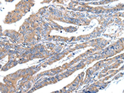 The image on the left is immunohistochemistry of paraffin-embedded Human esophagus cancer tissue using ZFAND2A Antibody(ZFAND2A Antibody) at dilution 1/30, on the right is treated with synthetic peptide. (Original magnification: ×200)Rabbit anti-Human ZFAND2A Polyclonal Antibody