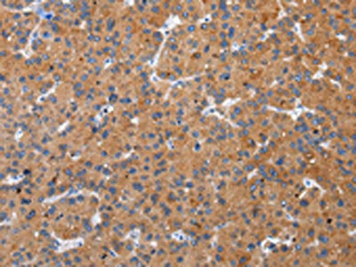 The image on the left is immunohistochemistry of paraffin-embedded Human liver cancer tissue using the antibody Antibody) at dilution 1/30, on the right is treated with synthetic peptide. (Original magnification: ×200)Rabbit anti-Human ZFAND2A Polyclonal Antibody