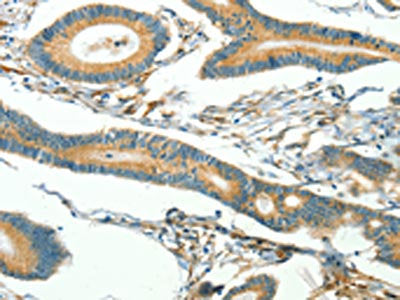 The image on the left is immunohistochemistry of paraffin-embedded Human thyroid cancer tissue using CAV3 Antibody(CAV3 Antibody) at dilution 1/40, on the right is treated with synthetic peptide. (Original magnification: ×200)