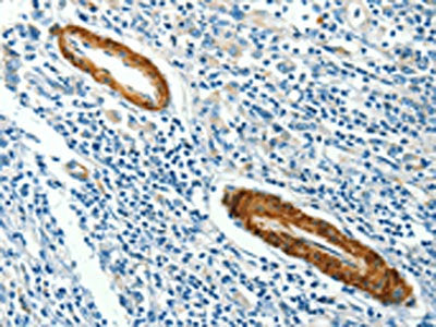 The image on the left is immunohistochemistry of paraffin-embedded Human gastic cancer tissue using the antibody Antibody) at dilution 1/40, on the right is treated with synthetic peptide. (Original magnification: ×200)