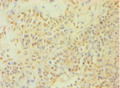 Immunohistochemistry of paraffin-embedded human breast cancer using CASP1 Antibody at dilution of 1:100