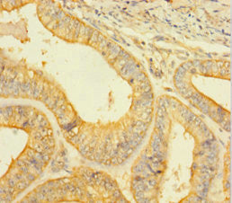 Immunohistochemistry of paraffin-embedded human endometrial cancer using the antibody at dilution of 1:100