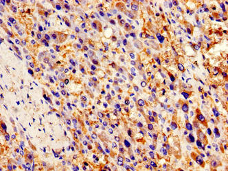 Immunohistochemistry of paraffin-embedded human liver cancer using CCL2 Antibody at dilution of 1:100Rabbit anti-Human CCL2 Polyclonal Antibody