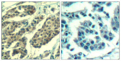 Immunohistochemical analysis of paraffin-embedded human breast carcinoma tissue using Cyclin B1(Phospho-Ser147) Antibody(left) or the same antibody preincubated with blocking peptide(right).Rabbit anti-Human CCNB1 Polyclonal Antibody