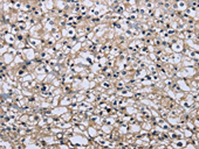 The image on the left is immunohistochemistry of paraffin-embedded Human prostate cancer tissue using MAPRE3 Antibody(MAPRE3 Antibody) at dilution 1/20, on the right is treated with fusion protein. (Original magnification: ×200)