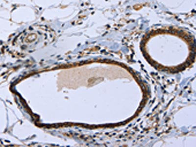 The image on the left is immunohistochemistry of paraffin-embedded Human breast cancer tissue using the antibody Antibody) at dilution 1/20, on the right is treated with fusion protein. (Original magnification: ×200)