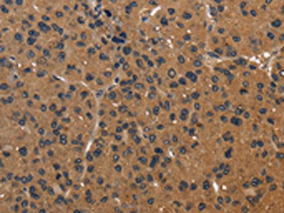 The image on the left is immunohistochemistry of paraffin-embedded Human liver cancer tissue using the antibody Antibody) at dilution 1/50, on the right is treated with fusion protein. (Original magnification: ×200)Rabbit anti-Human ICAM4 Polyclonal Antibody