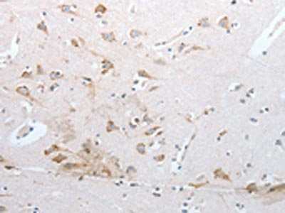 The image on the left is immunohistochemistry of paraffin-embedded Human brain tissue using RNF126 Antibody(RNF126 Antibody) at dilution 1/20, on the right is treated with synthetic peptide. (Original magnification: ×200)Rabbit anti-Human RNF126 Polyclonal Antibody