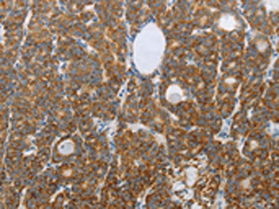 The image on the left is immunohistochemistry of paraffin-embedded Human thyroid cancer tissue using the antibody Antibody) at dilution 1/20, on the right is treated with synthetic peptide. (Original magnification: ×200)Rabbit anti-Human RNF126 Polyclonal Antibody
