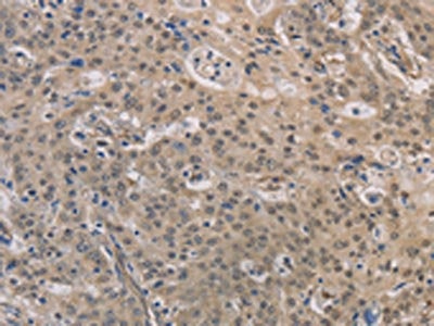 The image on the left is immunohistochemistry of paraffin-embedded Human gastric cancer tissue using DPYSL3 Antibody(DPYSL3 Antibody) at dilution 1/30, on the right is treated with fusion protein. (Original magnification: ×200)Rabbit anti-Human DPYSL3 Polyclonal Antibody