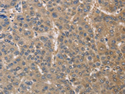 The image on the left is immunohistochemistry of paraffin-embedded Human liver cancer tissue using the antibody Antibody) at dilution 1/30, on the right is treated with fusion protein. (Original magnification: ×200)Rabbit anti-Human DPYSL3 Polyclonal Antibody