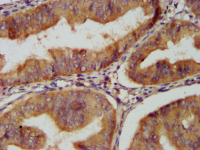 IHC image of the antibody diluted at 1:200 and staining in paraffin-embedded human endometrial cancer performed on a Leica BondTM system. After dewaxing and hydration, antigen retrieval was mediated by high pressure in a citrate buffer (pH 6.0). Section was blocked with 10% normal goat serum 30min at RT. Then primary antibody (1% BSA) was incubated at 4°C overnight. The primary is detected by a biotinylated secondary antibody and visualized using an HRP conjugated SP system.Rabbit anti-Human CLU Polyclonal Antibody