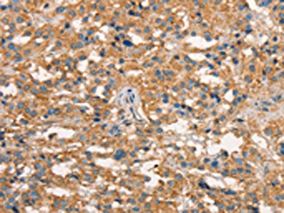 The image on the left is immunohistochemistry of paraffin-embedded Human thyroid cancer tissue using ART4 Antibody(ART4 Antibody) at dilution 1/50, on the right is treated with synthetic peptide. (Original magnification: ×200)Rabbit anti-Human ART4 Polyclonal Antibody