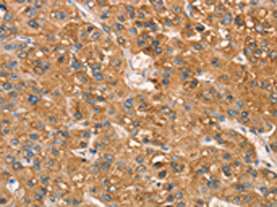 The image on the left is immunohistochemistry of paraffin-embedded Human liver cancer tissue using the antibody Antibody) at dilution 1/50, on the right is treated with synthetic peptide. (Original magnification: ×200)Rabbit anti-Human ART4 Polyclonal Antibody