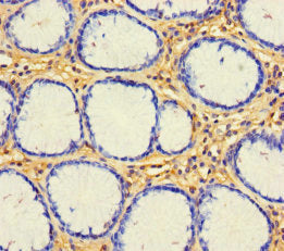 Immunohistochemistry of paraffin-embedded human gastric cancer using CX3CL1 Antibody at dilution of 1:100Rabbit anti-Human CX3CL1 Polyclonal Antibody