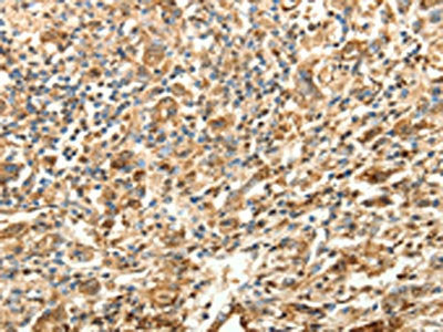 The image on the left is immunohistochemistry of paraffin-embedded Human gastric cancer tissue using SLC25A11 Antibody(SLC25A11 Antibody) at dilution 1/30, on the right is treated with fusion protein. (Original magnification: ×200)Rabbit anti-Human SLC25A11 Polyclonal Antibody