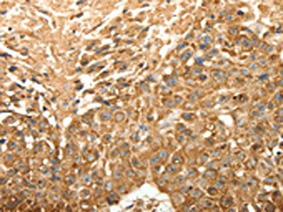 The image on the left is immunohistochemistry of paraffin-embedded Human esophagus cancer tissue using the antibody Antibody) at dilution 1/30, on the right is treated with fusion protein. (Original magnification: ×200)Rabbit anti-Human SLC25A11 Polyclonal Antibody