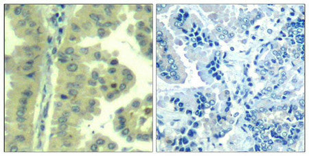Immunohistochemical analysis of paraffin-embedded human lung carcinoma tissue using eIF4G(Ab-1232) Antibody(left) or the same antibody preincubated with blocking peptide(right).Rabbit anti-Human EIF4G1 Polyclonal Antibody