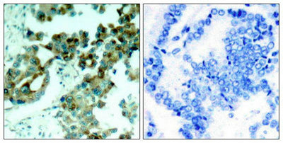 Immunohistochemical analysis of paraffin- embedded human lung carcinoma tissue using S6 Ribosomal Protein(Ab-235) Antibody(left) or the same antibody preincubated with blocking peptide(right).Rabbit anti-Human RPS6 Polyclonal Antibody