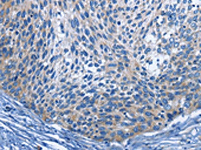 The image on the left is immunohistochemistry of paraffin-embedded Human cervical cancer tissue using IL2RB Antibody(IL2RB Antibody) at dilution 1/30, on the right is treated with fusion protein. (Original magnification: ×200)Rabbit anti-Human IL2RB Polyclonal Antibody