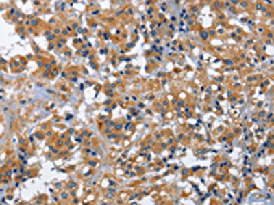 The image on the left is immunohistochemistry of paraffin-embedded Human thyroid cancer tissue using the antibody Antibody) at dilution 1/30, on the right is treated with fusion protein. (Original magnification: ×200)Rabbit anti-Human IL2RB Polyclonal Antibody