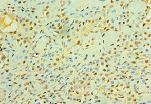 Immunohistochemistry of paraffin-embedded human breast cancer using CST3 Antibody at dilution of 1:100Rabbit anti-Human CST3 Polyclonal Antibody