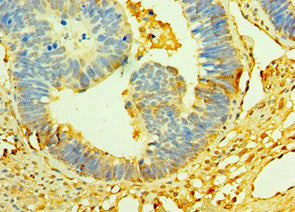 Immunohistochemistry of paraffin-embedded human ovarian cancer using CST3 Antibody at dilution of 1:100Rabbit anti-Human CST3 Polyclonal Antibody