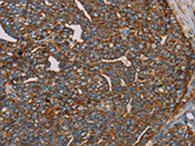 The image on the left is immunohistochemistry of paraffin-embedded Human cervical cancer tissue using MRPL28 Antibody(MRPL28 Antibody) at dilution 1/45, on the right is treated with fusion protein. (Original magnification: ×200)Rabbit anti-Human MRPL28 Polyclonal Antibody