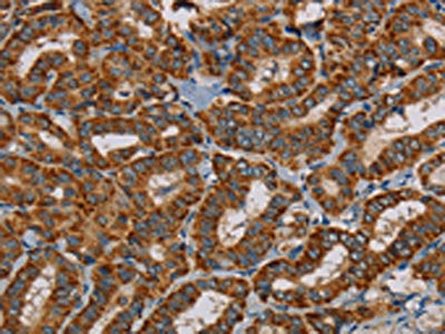 The image on the left is immunohistochemistry of paraffin-embedded Human thyroid cancer tissue using the antibody Antibody) at dilution 1/45, on the right is treated with fusion protein. (Original magnification: ×200)
