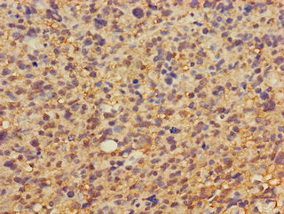 Immunohistochemistry of paraffin-embedded human glioma using DKK1 Antibody at dilution of 1:100Rabbit anti-Human DKK1 Polyclonal Antibody