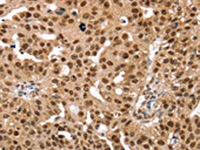 The image on the left is immunohistochemistry of paraffin-embedded Human breast cancer tissue using the antibody Antibody) at dilution 1/30, on the right is treated with fusion protein. (Original magnification: ×200)Rabbit anti-Human SMARCB1 Polyclonal Antibody