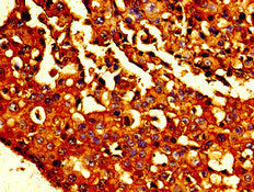 Immunohistochemistry of paraffin-embedded human breast cancer using the antibody at dilution of 1:100Rabbit anti-Human CDH1 Polyclonal Antibody