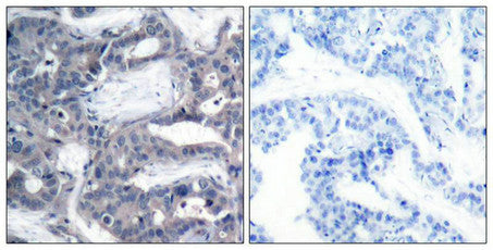 Immunohistochemical analysis of paraffin-embedded human breast carcinoma tissue using MEK-2(Phospho-Thr394) Antibody(left) or the same antibody preincubated with blocking peptide(right).