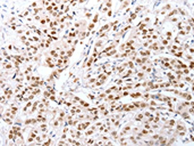 The image on the left is immunohistochemistry of paraffin-embedded Human breast cancer tissue using CTBP2 Antibody(CTBP2 Antibody) at dilution 1/25, on the right is treated with fusion protein. (Original magnification: ×200)Rabbit anti-Human CTBP2 Polyclonal Antibody