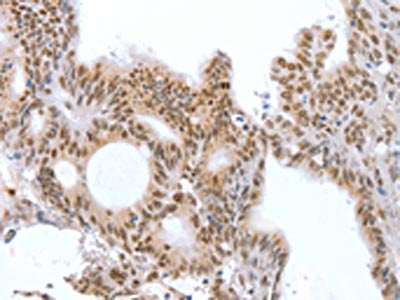 The image on the left is immunohistochemistry of paraffin-embedded Human colon cancer tissue using the antibody Antibody) at dilution 1/25, on the right is treated with fusion protein. (Original magnification: ×200)Rabbit anti-Human CTBP2 Polyclonal Antibody