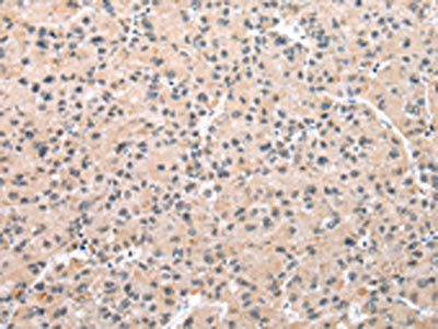 The image on the left is immunohistochemistry of paraffin-embedded Human liver cancer tissue using WDR5 Antibody(WDR5 Antibody) at dilution 1/30, on the right is treated with fusion protein. (Original magnification: ×200)Rabbit anti-Human WDR5 Polyclonal Antibody