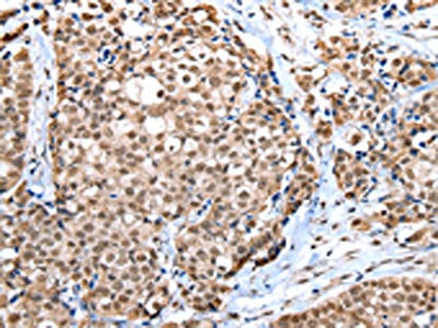 The image on the left is immunohistochemistry of paraffin-embedded Human breast cancer tissue using the antibody Antibody) at dilution 1/30, on the right is treated with fusion protein. (Original magnification: ×200)Rabbit anti-Human WDR5 Polyclonal Antibody