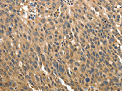 The image on the left is immunohistochemistry of paraffin-embedded Human ovarian cancer tissue using MSN Antibody(MSN Antibody) at dilution 1/30, on the right is treated with fusion protein. (Original magnification: ×200)Rabbit anti-Human MSN Polyclonal Antibody