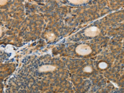 The image on the left is immunohistochemistry of paraffin-embedded Human thyroid cancer tissue using the antibody Antibody) at dilution 1/30, on the right is treated with fusion protein. (Original magnification: ×200)Rabbit anti-Human MSN Polyclonal Antibody