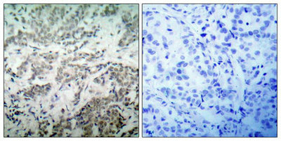 Immunohistochemical analysis of paraffin-embedded human breast carcinoma tissue using p53(Ab-15) Antibody(left) or the same antibody preincubated with blocking peptide(right).Rabbit anti-Human TP53 Polyclonal Antibody