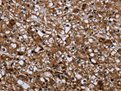 The image on the left is immunohistochemistry of paraffin-embedded Human prostate cancer tissue using the antibody Antibody) at dilution 1/40, on the right is treated with fusion protein. (Original magnification: ×200)Rabbit anti-Human GALT Polyclonal Antibody