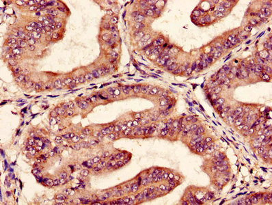 Immunohistochemistry of paraffin-embedded human endometrial cancer using EPO Antibody at dilution of 1:100Rabbit anti-Human EPO Polyclonal Antibody