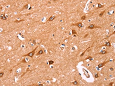 The image on the left is immunohistochemistry of paraffin-embedded Human brain  tissue using NCEH1 Antibody(NCEH1 Antibody) at dilution 1/80, on the right is treated with fusion protein. (Original magnification: ×200)Rabbit anti-Human NCEH1 Polyclonal Antibody
