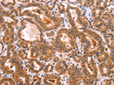 The image on the left is immunohistochemistry of paraffin-embedded Human thyroid cancer tissue using the antibody Antibody) at dilution 1/80, on the right is treated with fusion protein. (Original magnification: ×200)Rabbit anti-Human NCEH1 Polyclonal Antibody