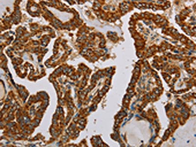 The image on the left is immunohistochemistry of paraffin-embedded Human thyroid cancer tissue using the antibody Antibody) at dilution 1/50, on the right is treated with fusion protein. (Original magnification: ×200)Rabbit anti-Human NDUFS5 Polyclonal Antibody